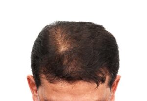 Hair Care After Hair Transplant By Virginia Surgical Center
