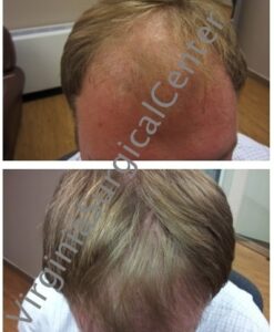 Before and After Hair Loss Procedure at Virginia Surgical Center
