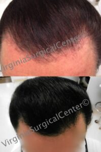 Before and After Trichophytic Donor Closure at Virginia Surgical Center