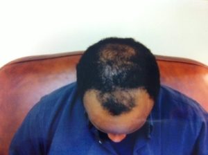 Dense Packing Hair Transplant by Virginia Surgical Center