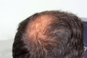 Trichophytic Closure for Hair Transplant at Virginia Surgical Center