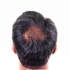 Hair Restoration Procedures at Virginia Surgical Center